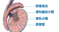 附睾炎怎么治疗？