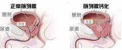 新乡治疗前列腺钙化哪家医院好？