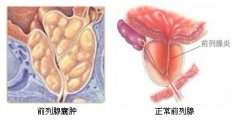 新乡治疗前列腺囊肿多少钱？